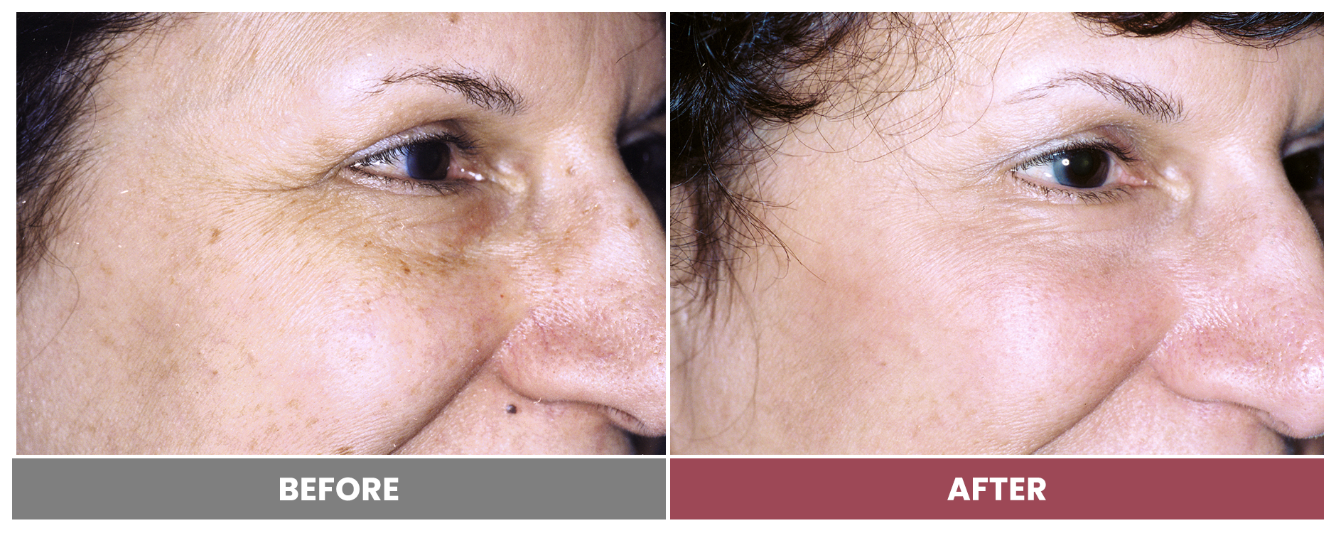 LASER SKIN RESURFACING - Case 11